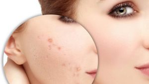 Những điều cần lưu ý khi điều trị sẹo rỗ trên mặt