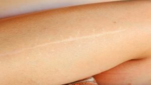 Có rất nhiều nguyên nhân gây ra các vết sẹo trắng mất thẩm mỹ