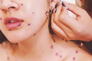 Bệnh thủy đậu có thể để lại những vết sẹo đáng ghét trên da