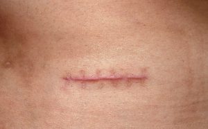 Vết sẹo có màu đỏ là nỗi e ngại của nhiều người, nhất là phái đẹp