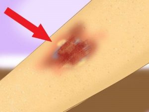 Bị vết thương bị mưng mủ kiêng ăn gì?