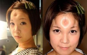 Vết sẹo lõm trên trán lâu năm