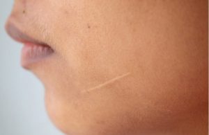 Sẹo trắng hình thành vì sao?