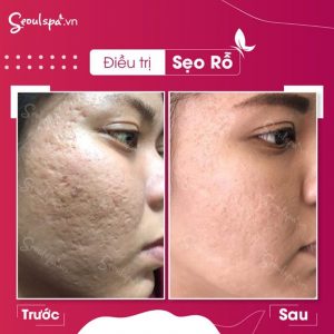 Top 10 spa trị sẹo tại Quảng Ngãi đảm bảo an toàn, uy tín nhất