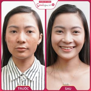 Làn da trắng sáng không tì vết sau khi điều trị sẹo tại SeoulSpa.Vn