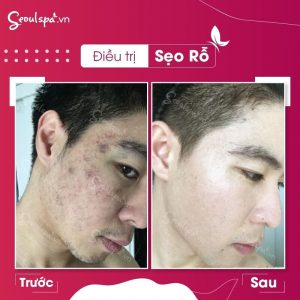 Hiệu quả trị sẹo rõ rệt khi thực hiện tại SeoulSpa.Vn