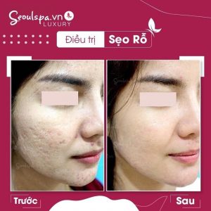 SeoulSpa.Vn là địa chỉ trị sẹo tại Cần Thơ uy tín, được nhiều người chọn lựa