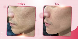 Trị sẹo tại Long An cùng SeoulSpa.Vn