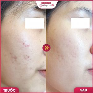 Các vết thâm do mụn cũng loại bỏ gần như hoàn toàn