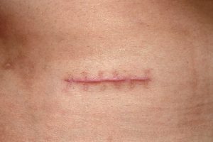 Sẹo phẫu thuật mất trung bình từ 3- 6 tháng để phục hồi