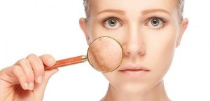 Vết sẹo rỗ trên mặt làm ảnh hưởng nghiêm trọng tới nhan sắc của bạn