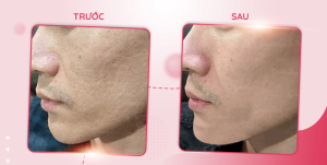 Kết quả trị sẹo của khách hàng khi điều trị tại SeoulSpa.Vn