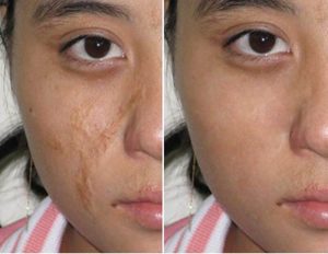 Vết sẹo lõm sẽ được xóa bỏ một cách rõ rệt sau khi được cấy ghép da tự thân