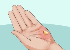 Bỏng là nguyên nhân hàng đầu gây ra bóng nước