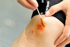 Sát khuẩn ngay sau khi xuất hiện vết thương tránh nhiễm trùng hiệu quả hơn