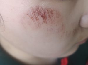 Có nhiều nguyên nhân gây trầy xước da mặt