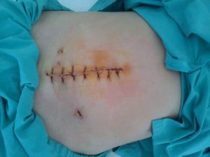 Vết mổ sau sinh khả năng hình thành sẹo rất lớn