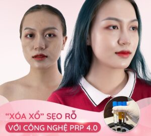 Trị sẹo bằng công nghệ độc quyền PRP 4.0 đem lại làn da mịn màng như mong đợi