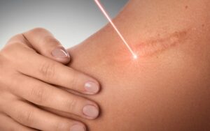 Trị sẹo lồi bằng laser là phương pháp trị sẹo hiện đại nhát hiện nay