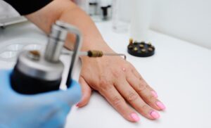 Trị sẹo lồi bằng nitơ lỏng là phương pháp trị sẹo lồi hiệu quả và khá an toàn