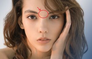 Về mặt thẩm mỹ, ấn đường có sẹo tốt hay xấu?