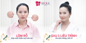 Trị sẹo tại Seoul Center mang lại kết quả cao chỉ sau 1 liệu trình