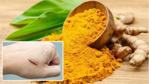 Nghệ giúp trị sẹo hiệu quả nhờ các hoạt chất như curcumin, vitamin E