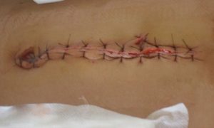 Cách xử lý khi vết thương sau cắt chỉ bị hở