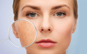 Vitamin C có tác dụng làm mờ sẹo rỗ hiệu quả trên da