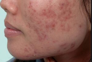 Sẹo mụn thâm rất dễ hình thành