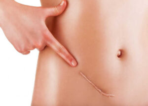 Hình 1: Thời điểm thích hợp để trị sẹo