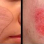 Cà da mặt trị sẹo rỗ có thật sự hiệu quả?