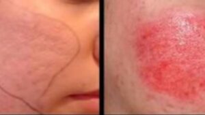 Cà da mặt trị sẹo rỗ có thật sự hiệu quả?