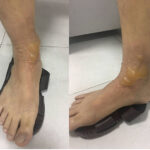 Bỏng nặng có hiện tượng phồng rộp