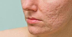 Sẹo rỗ hình thành do các tổn thương trên da