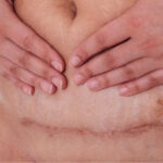 Nếu không sớm điều trị sẹo sẽ không thể nào hết tự nhiên