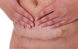 Nếu không sớm điều trị sẹo sẽ không thể nào hết tự nhiên