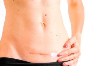 Collagen tác dụng tốt với việc trị sẹo vết khâu