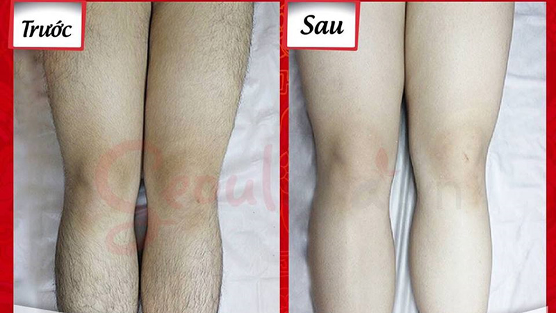 Hiệu quả triệt lông tuyệt vời