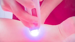 laser leg hair removal