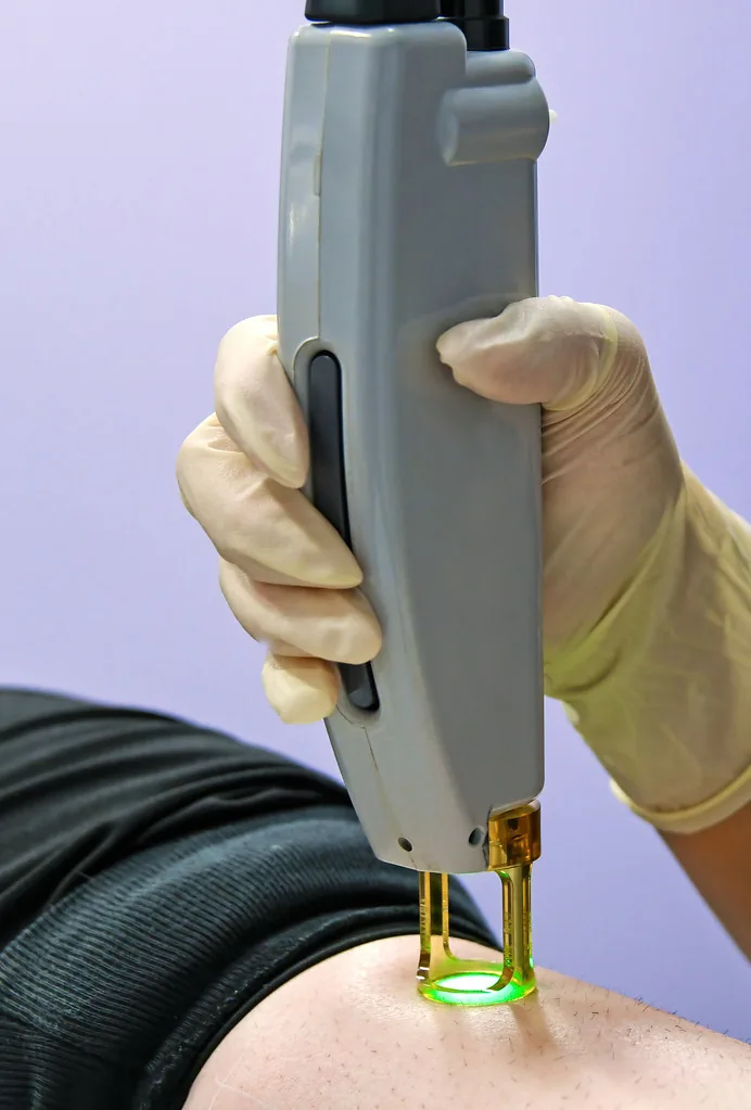 Triệt lông chân bằng laser hoạt động ra sao?