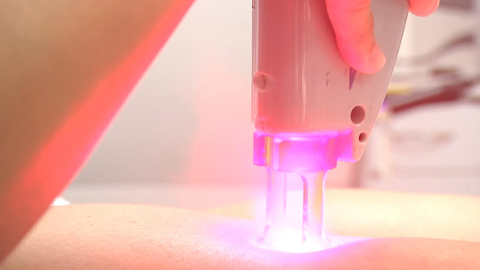 Các loại laser triệt lông chân có những ưu nhược điểm nào?