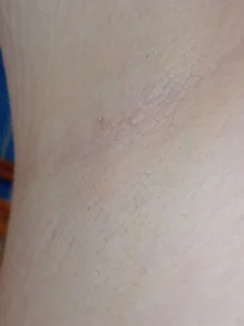 laser hair removal sessions