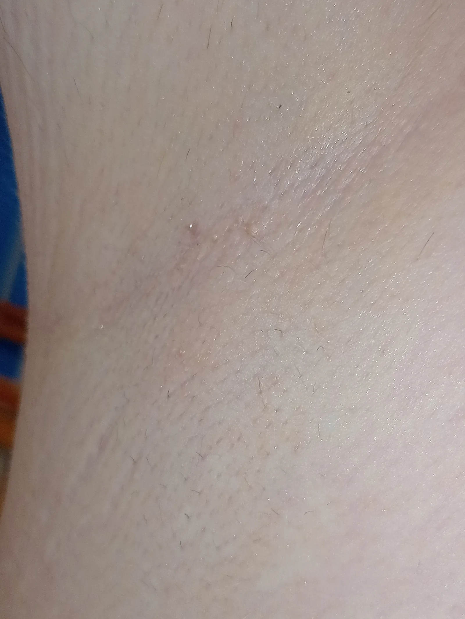 laser hair removal sessions