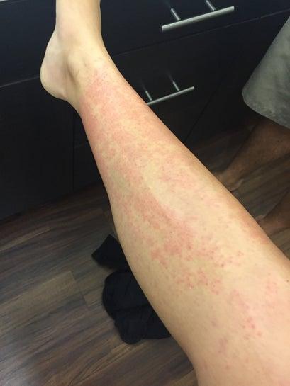 Cách chăm sóc da chân để giảm ngứa