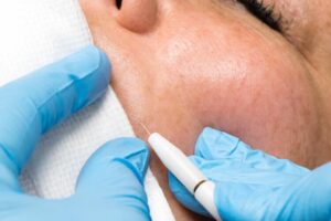 Đầu dò điện phân được đưa theo đường tự nhiên của nang lông trước khi truyền dòng điện kiểm soát.