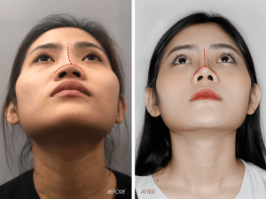 cắt cánh mũi bao lâu thì lành