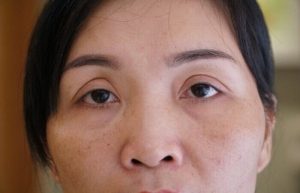 Tình trạng cắt mí sưng không đều