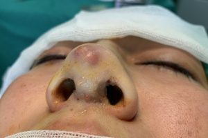 Dấu hiệu của lộ sống mũi sau nâng