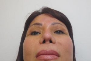 Dấu hiệu mũi bị bao xơ có thể thấy sau khi nâng